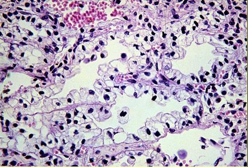 histologia - Imagen histolgica que muestra un tumor de clulas claras.